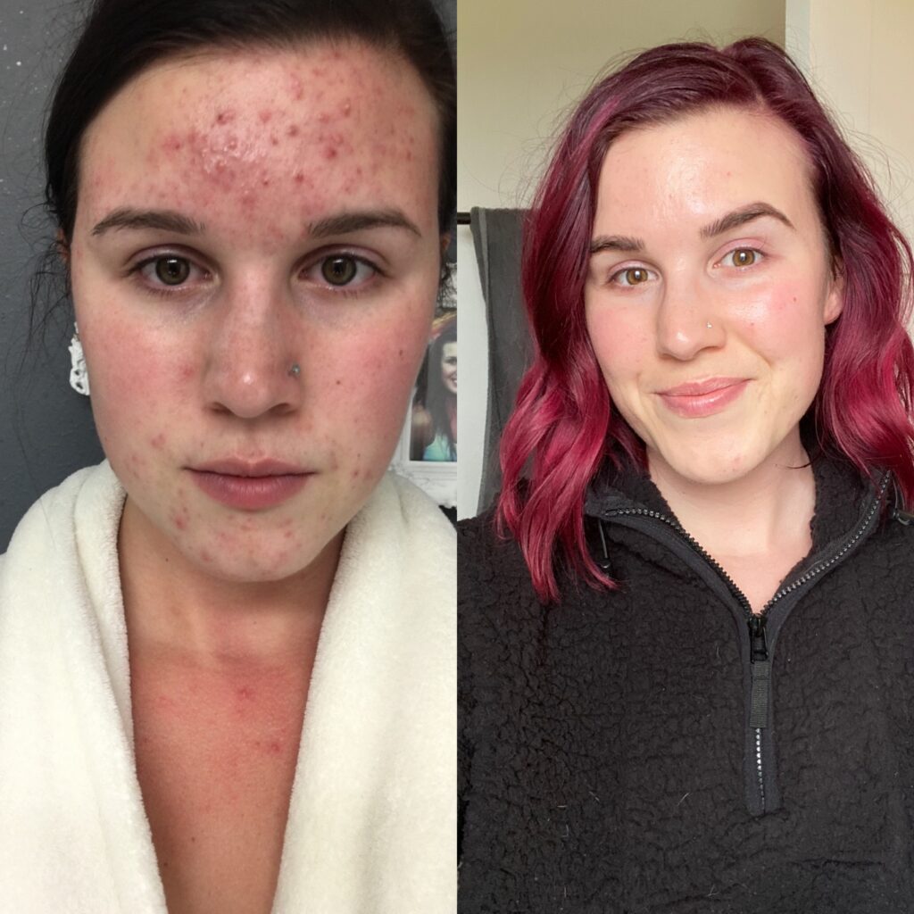 My Acne Journey - SkinGloss